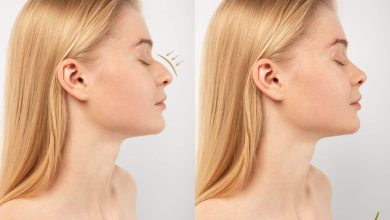 Como alcançar um resultado natural com a rinoplastia