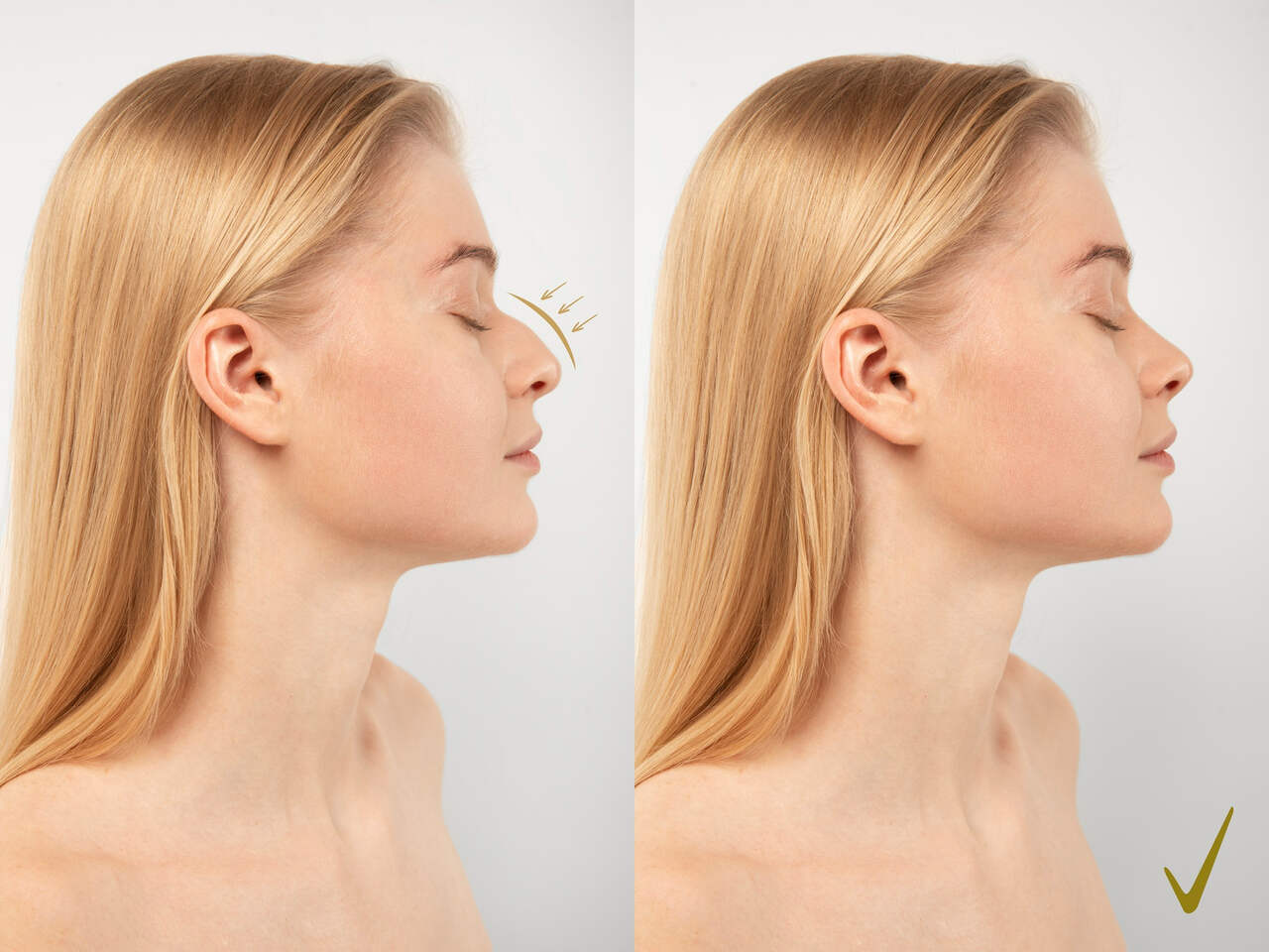 Como alcançar um resultado natural com a rinoplastia