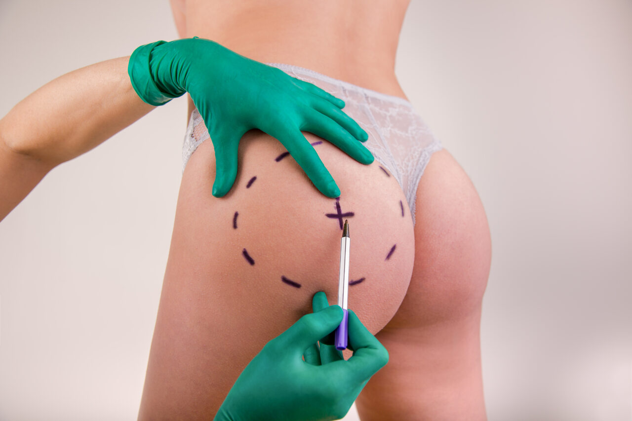 Saiba como a lipoenxertia usa sua gordura para esculpir novas curvas