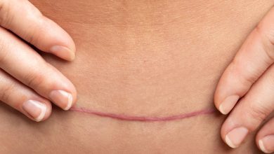 Como cuidar das cicatrizes após cirurgia plástica e garantir melhor resultado