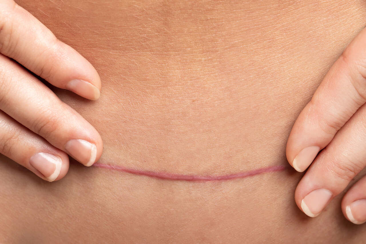 Como cuidar das cicatrizes após cirurgia plástica e garantir melhor resultado
