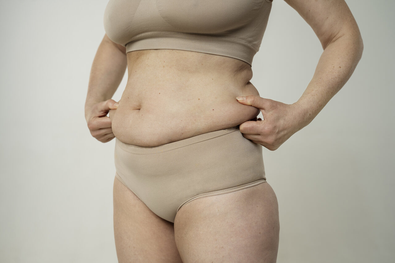 Abdominoplastia convencional quando está indicada e o que esperar do resultado